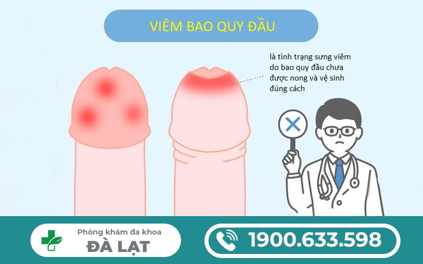 VIÊM BAO QUY ĐẦU : NGUYÊN NHÂN, DẤU HIỆU, CÁCH PHÒNG NGỪA